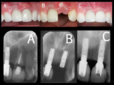 Tooth Implant