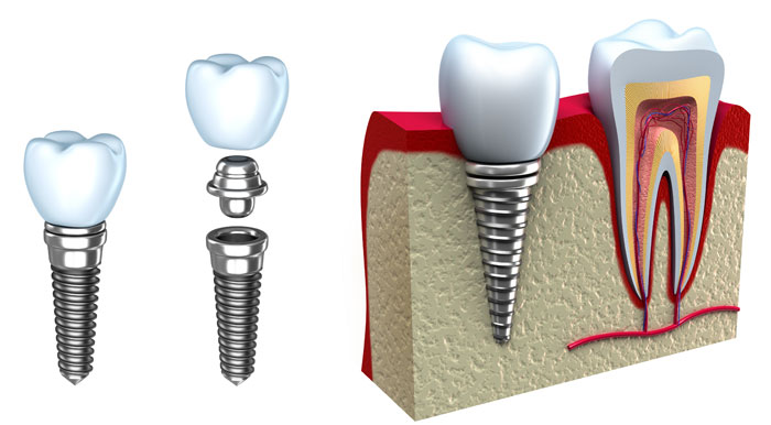 DentalImplant Full View