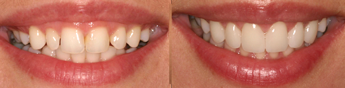 Esthetic Crown Lengthening