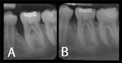 Bone Grafting