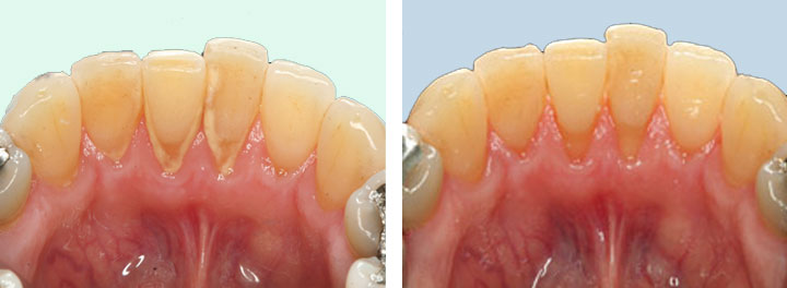 the process of cleaning teeth