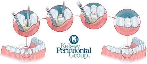 Functional Crown Lengthening