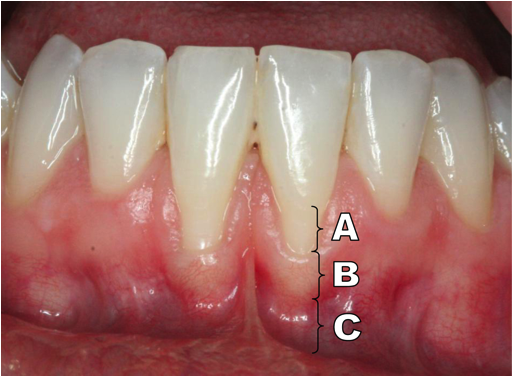 Review of Gingival Anatomy